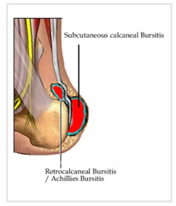 subcutaneous achilles bursitis