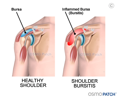 Shoulder Bursitis before & after - OSMO Patch - AU