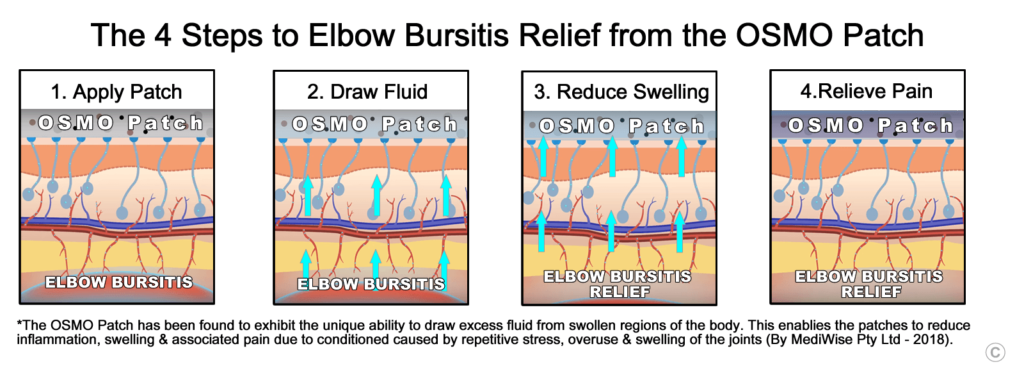 Elbow Bursitis Relief - OSMO Patch